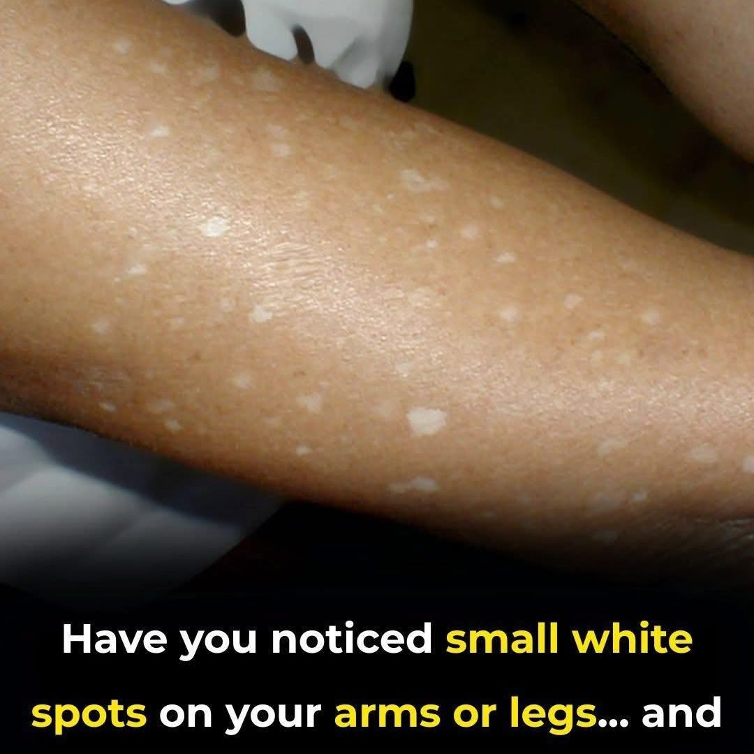 Understanding Small White Spots on the Arms and Legs 825356427_122181388118638015_5490413837247502187_n