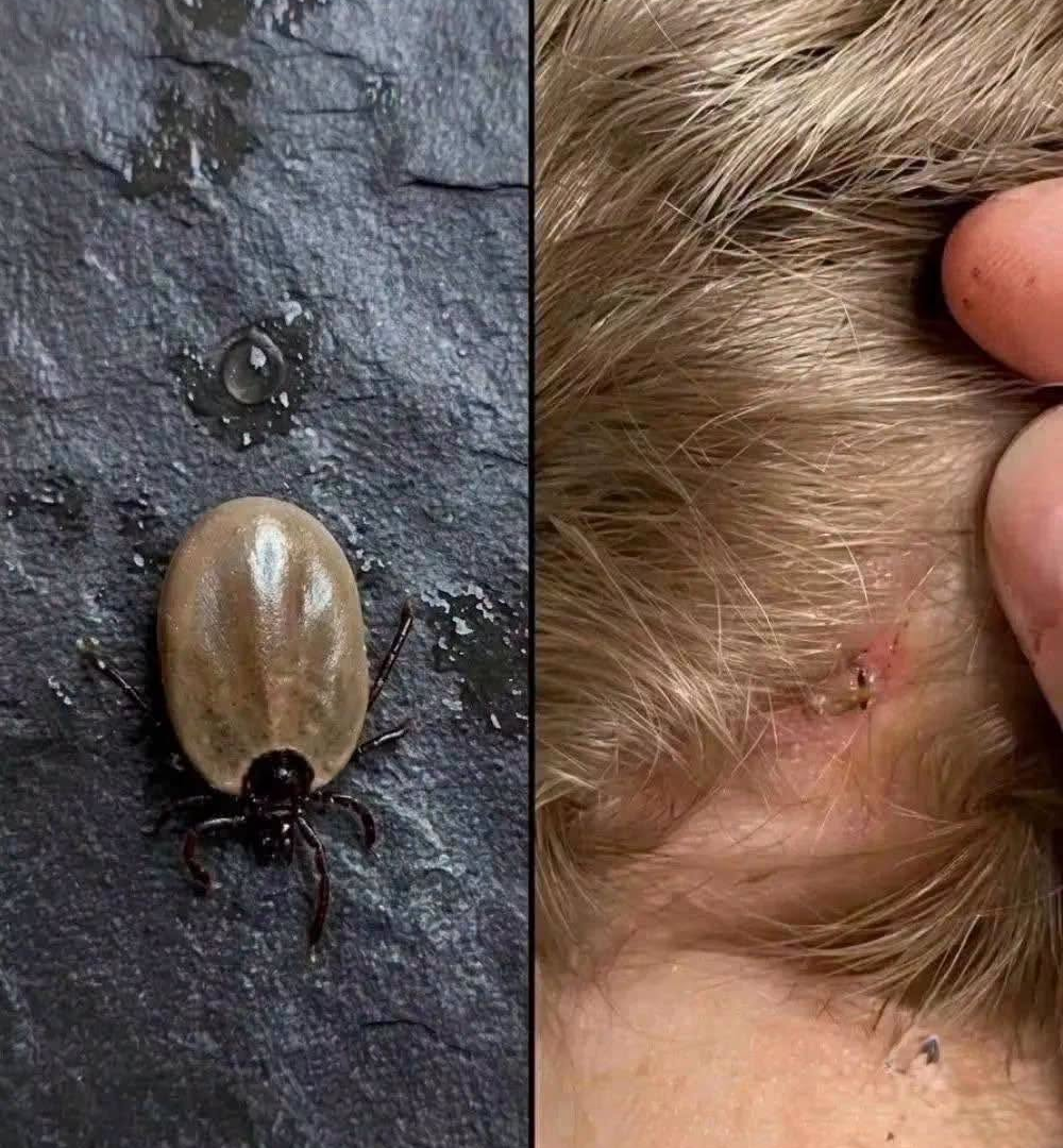 What to Do If You Find a Tick on Your Child image