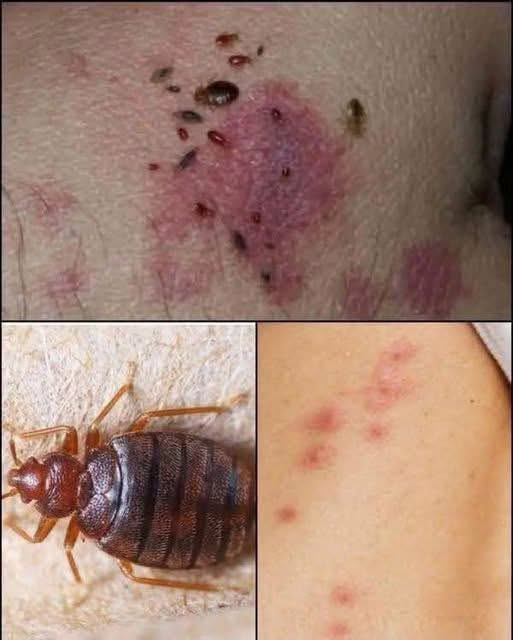 Understanding Bed Bug Bites and What to Do Next image