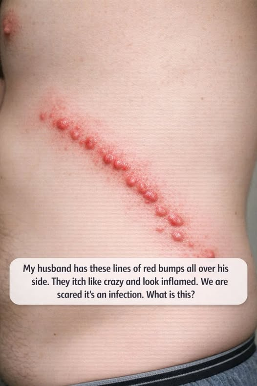 Understanding a Painful, Blistering Rash: When to Seek Medical Advice image