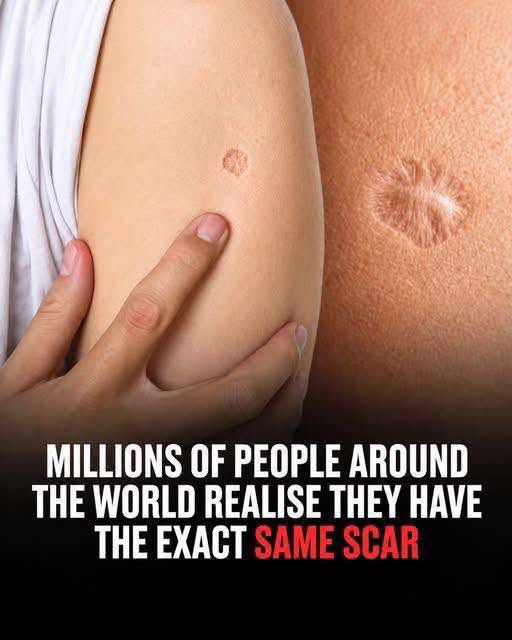 The Story Behind a Common Scar: What Is the BCG Vaccine? image